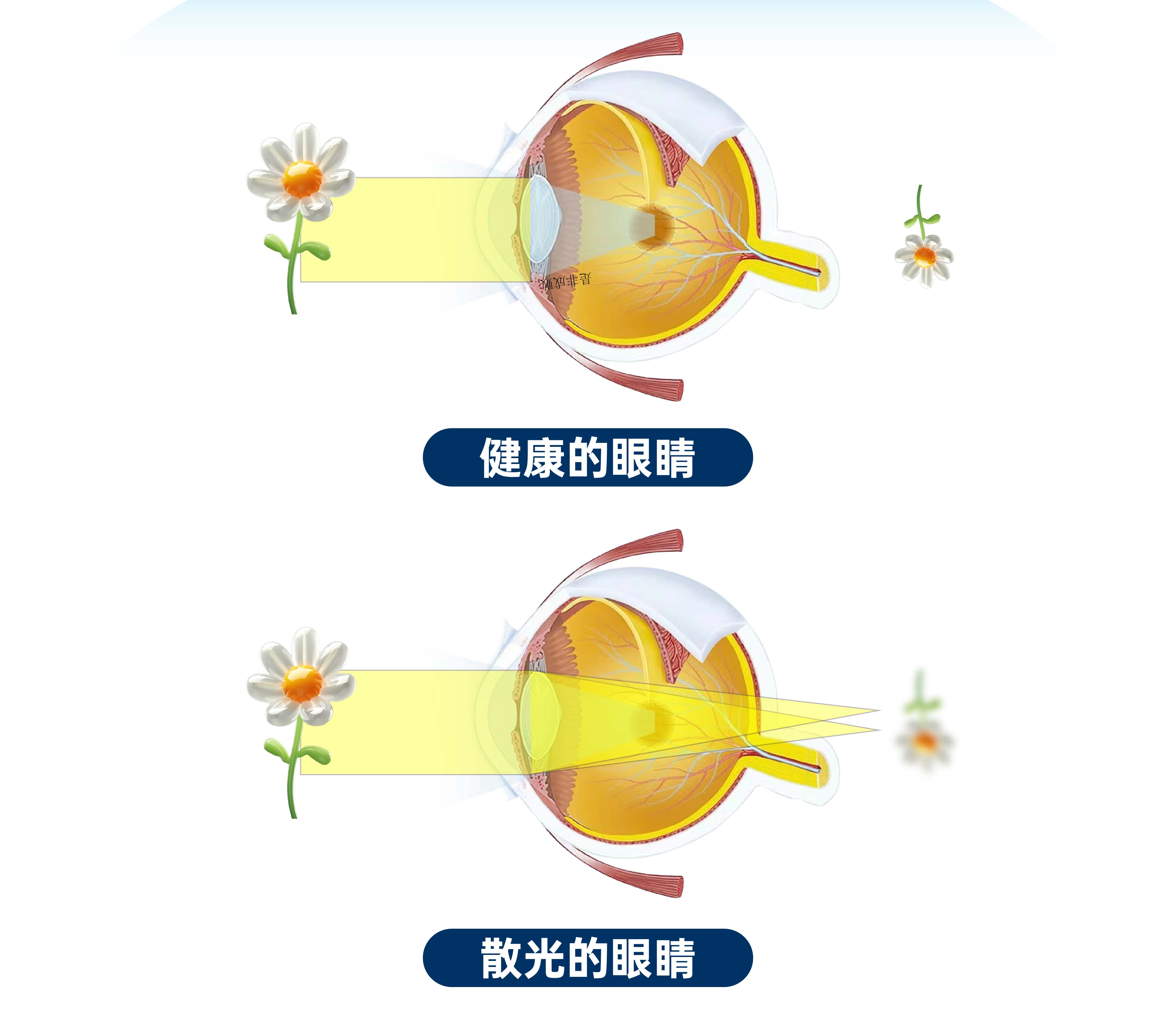 什么是散光