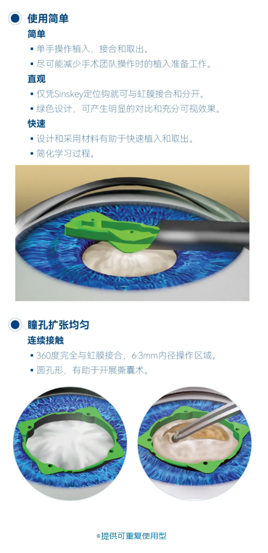 葡萄膜炎并发小瞳孔白内障的治疗