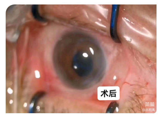 白内障医生的“神器”，小瞳孔“克星”
