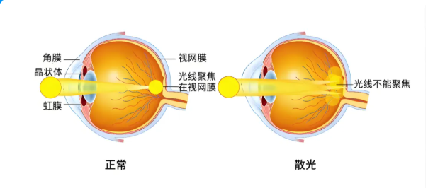 角膜切口的构型对白内障手术术源性散光的影响