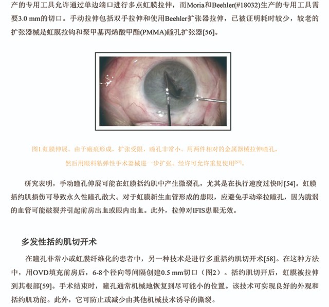 白内障手术中获得足够瞳孔大小的方法