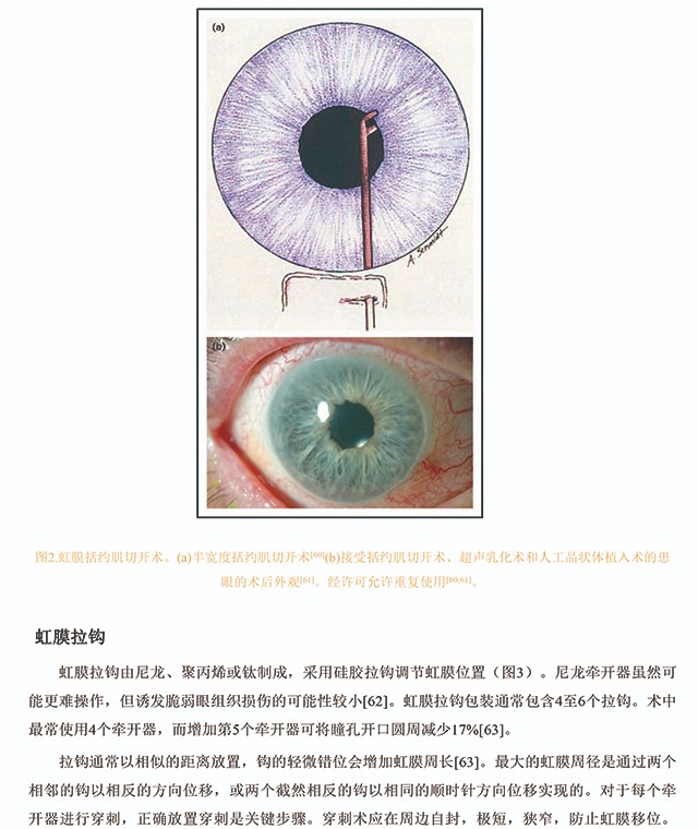 白内障手术中获得足够瞳孔大小的方法